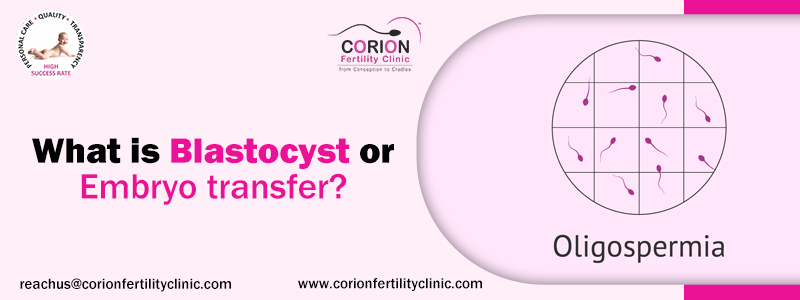 What is Blastocyst Transfer or day 3 Embryo Transfer?